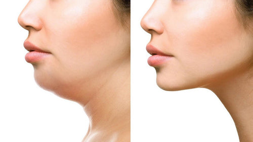 Get Rid of Double Chin With Double Chin Cosmetic Treatment Options at Bedford Skin Clinic in Halifax Nova Scotia